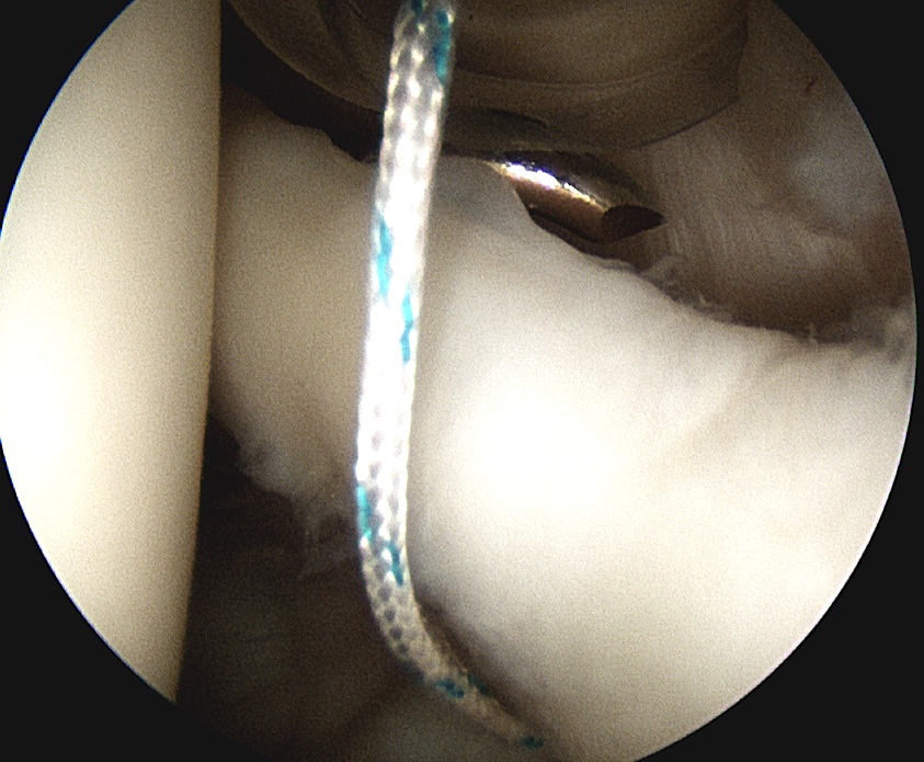 SLAP repair Anterior Anchor